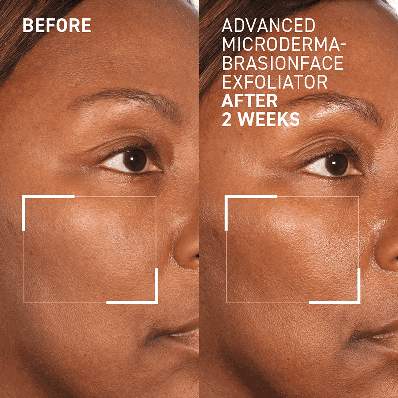 Microdermabrasion Face Exfoliator