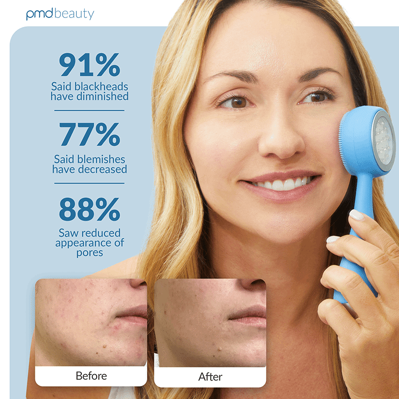 Clean Acne Cleansing Device with Blue Light Therapy