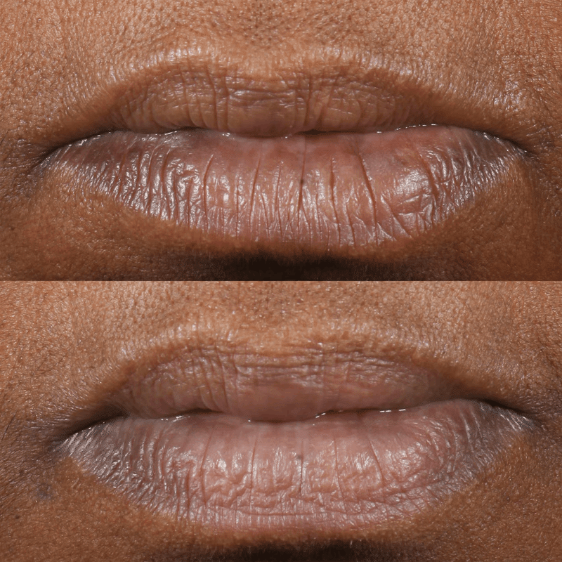 Cold Plasma Limited Edition Lip Therapy Black