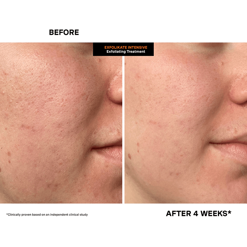 ExfoliKate® Intensive Exfoliating Treatment