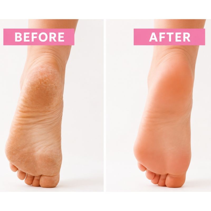 90 Minute Foot Renewal Mask Exfoliating Foot Peel
